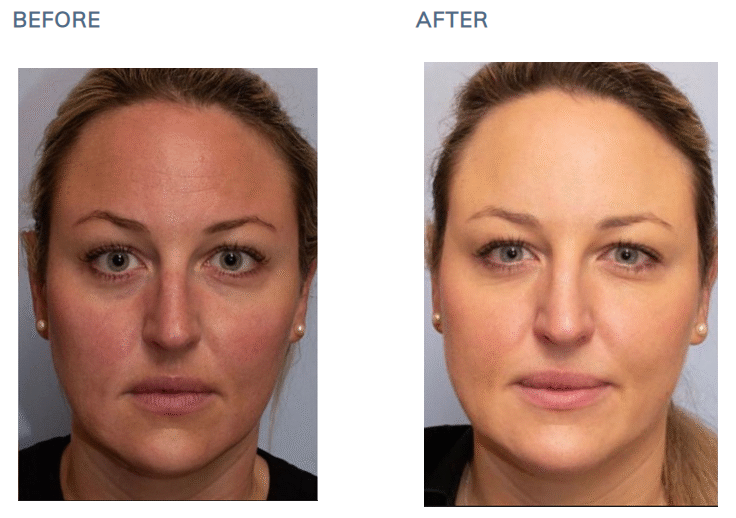 Sofwave™ Before After Face